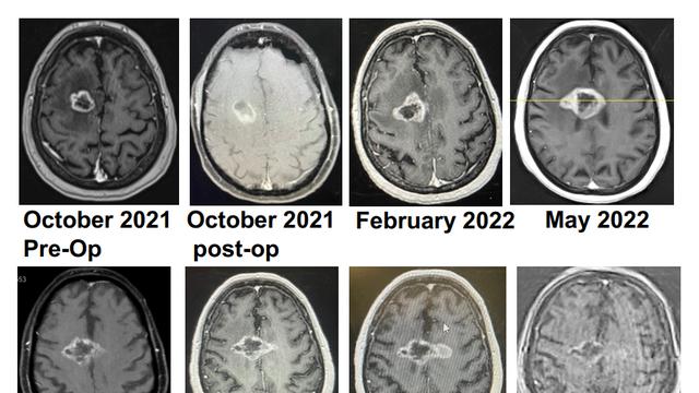 风险直降92%！除了HPV疫苗，这些癌症疫苗也已取得重大突破，肺癌、乳腺癌、肾癌……患者已受益