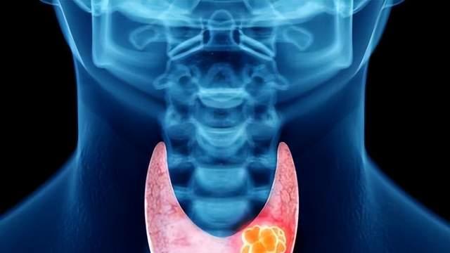 心慌手抖别硬扛，脖子变粗要警惕，小心甲亢，定期检查是关键