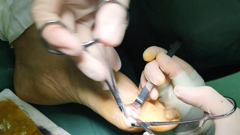 鸡蛋大的痛风石，为何医生劝你别急着开刀？