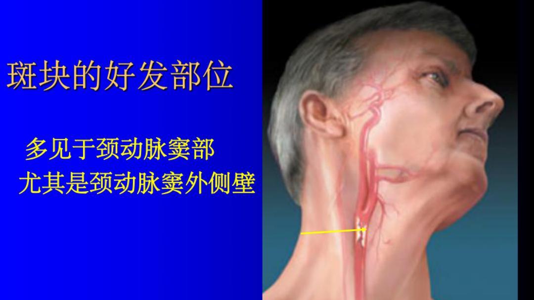 治疗颈动脉斑块的方剂：补阳还五汤，瓜蒌薤白半夏汤，镇肝熄风汤