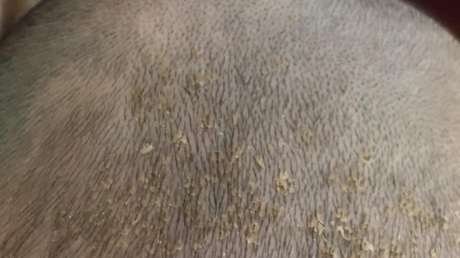 宝宝头上的乳痂你知道怎么解决了吗？