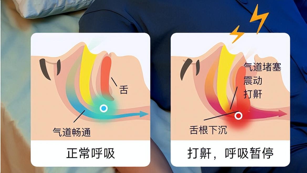告别鼾声困扰！云触智能舒鼾枕M1：用黑科技守护全家好睡眠