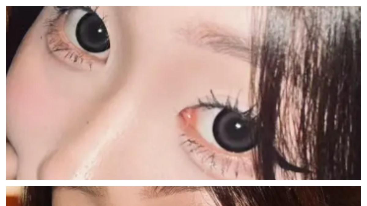 玻尿酸丰卧蚕实录，术前VS术后，get楚楚可怜大眼萌妹！