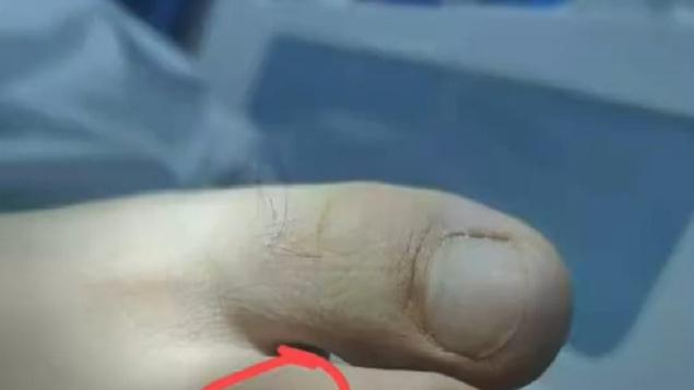 女子疑被蛇咬身亡伤口曝光！大概能明白为啥会延误病情了