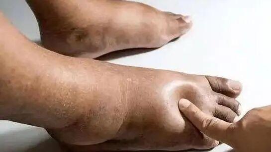 尿酸超标不声不响？5个典型表现+1个隐蔽信号，早发现早护肾！