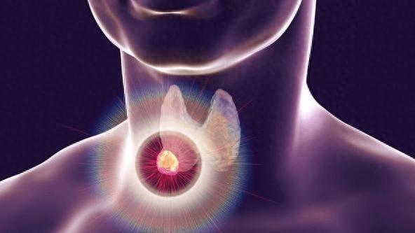 体检查出甲状腺结节？别慌！95%都是"假敌人"，别再被结节吓破胆