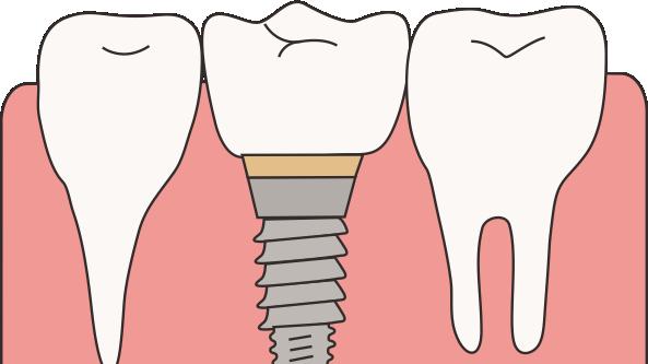 做完种植牙，这5件事千万别采坑