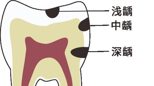 提醒：牙齿出现这种“假好转”，千万别拖！当心治疗费翻十倍