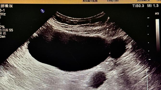 品质国文丨国文医院精准影像 + 规范流程，攻克复杂输卵管积水病例