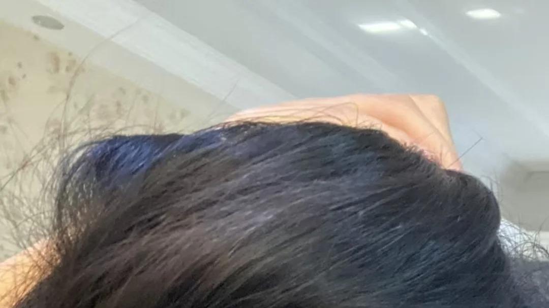 郑州植发避坑指南｜我的NOHS不剃发日记