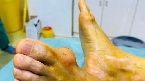 痛风石不手术能消吗？3个温和方法，融石护关节不遭罪！