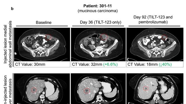 肿瘤缩小69%！溶瘤病毒在ESMO 2025大放异彩，晚期卵巢癌、食管癌等患者的新选择