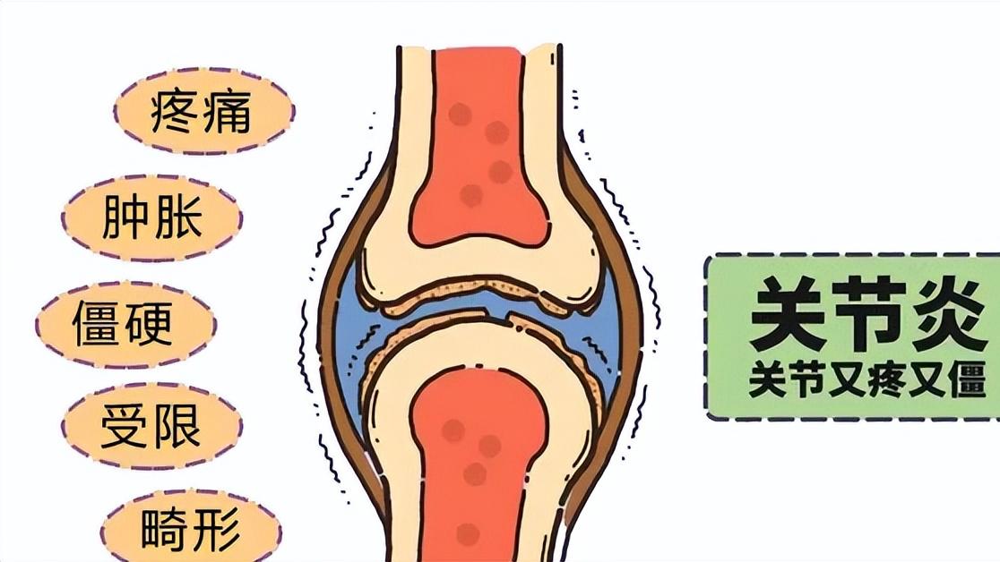 膝盖寿命只有60年？这些伤膝行为，很多人天天在做！