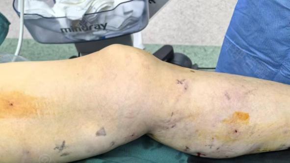 关注半年才敢来！70岁老人认准联合微创，3个针眼治好了腿上的“鼓包”