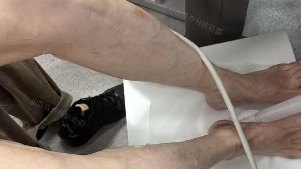 江苏65岁大叔静脉曲张，腿上“皮疹”担心变老烂腿，30分钟微创解除困扰