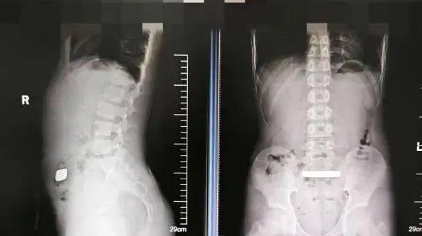 惊险！11岁男孩误吞100克金条，医生半小时“拆弹”成功