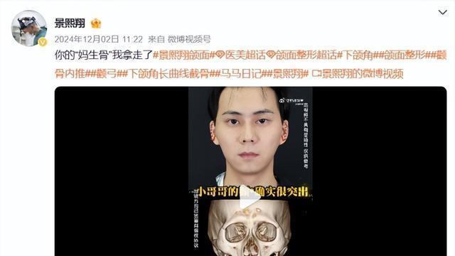 男子整容颧骨骨折后续：院长问AI原因，维权遭污蔑，医生身份曝光