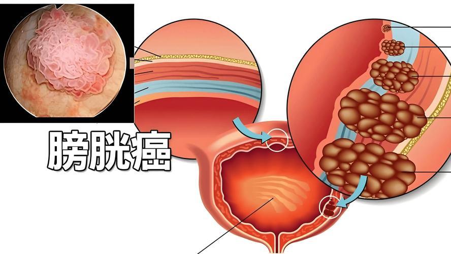 膀胱癌早期血尿，往往不痛不痒，别忽视错过黄金干预期！
