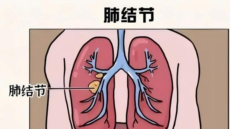 发现肺结节？别慌！90%是良性，5类人群做好早期预防