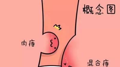 上厕所时间越久越容易得痔疮吗？