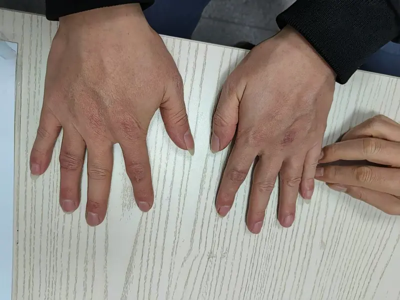 长痛风石之后就不痛了还要治吗？