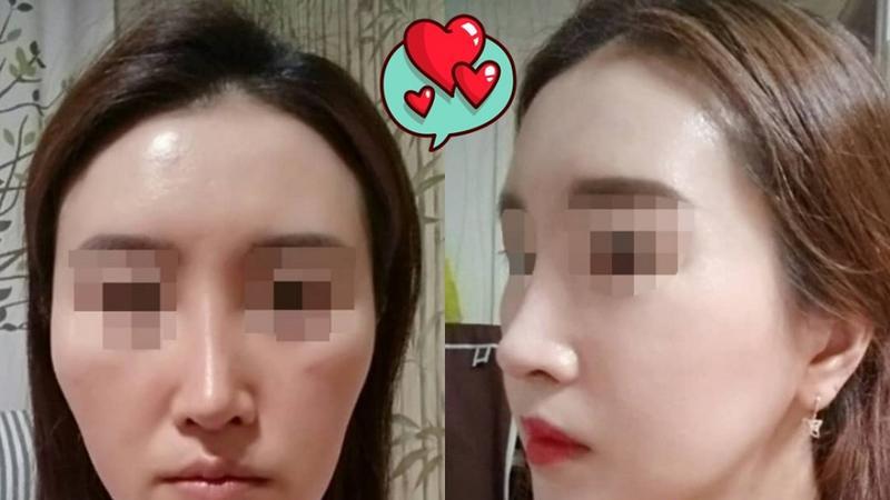 专业解答：脂肪填充多久成活稳定？多久恢复自然？