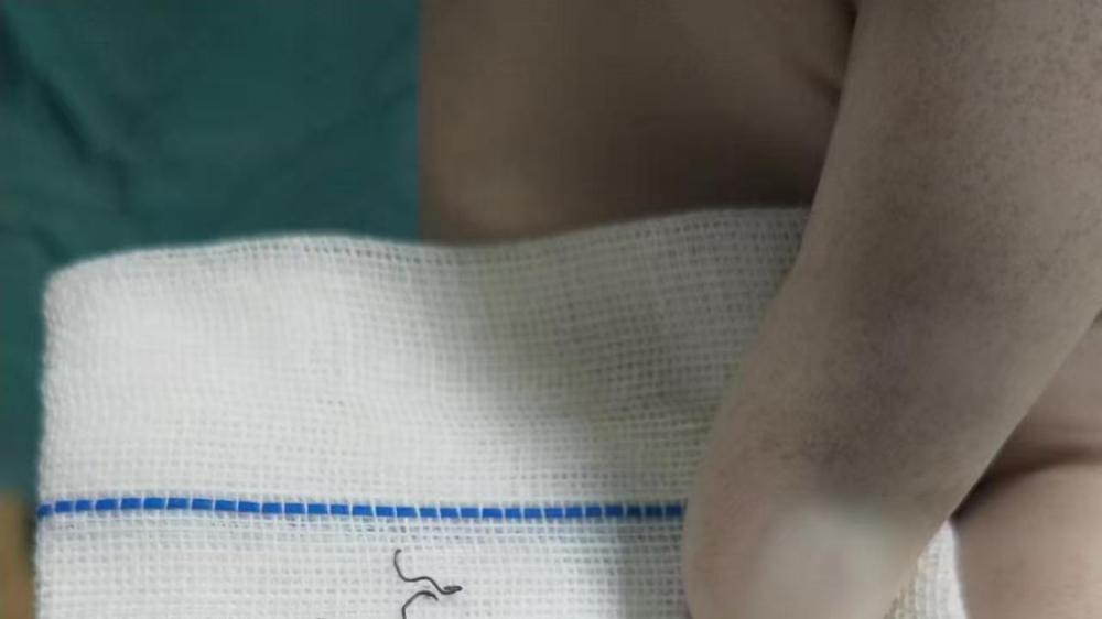 女子做痔疮手术留“隐患”：10年8次手术取出30多枚钛钉；法院判赔62万