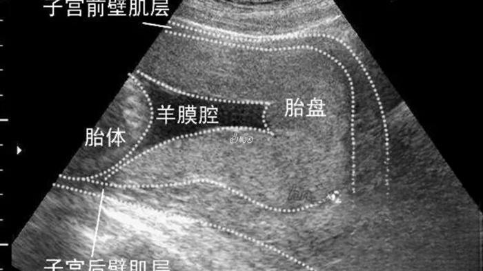 男孩一般在前壁还是后壁？附胎盘位置看胎儿性别的方法