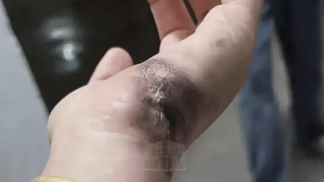 就一眨眼的功夫，安徽宿州的刘女士手就烧黑了。