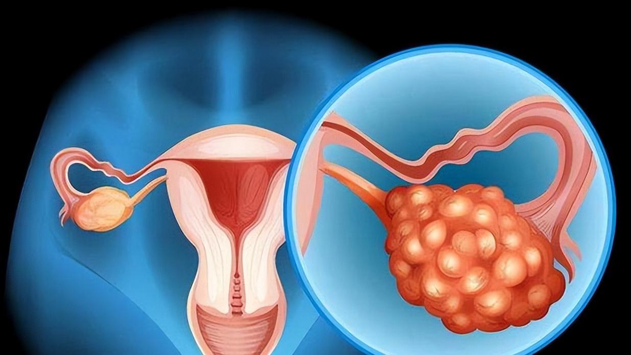 长期腹胀尿频，可能卵巢癌作怪，治疗要趁早，早期生存率80%以上