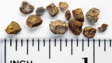 《你也可以优雅健康地生活》第二章，治疗结石的食疗方子