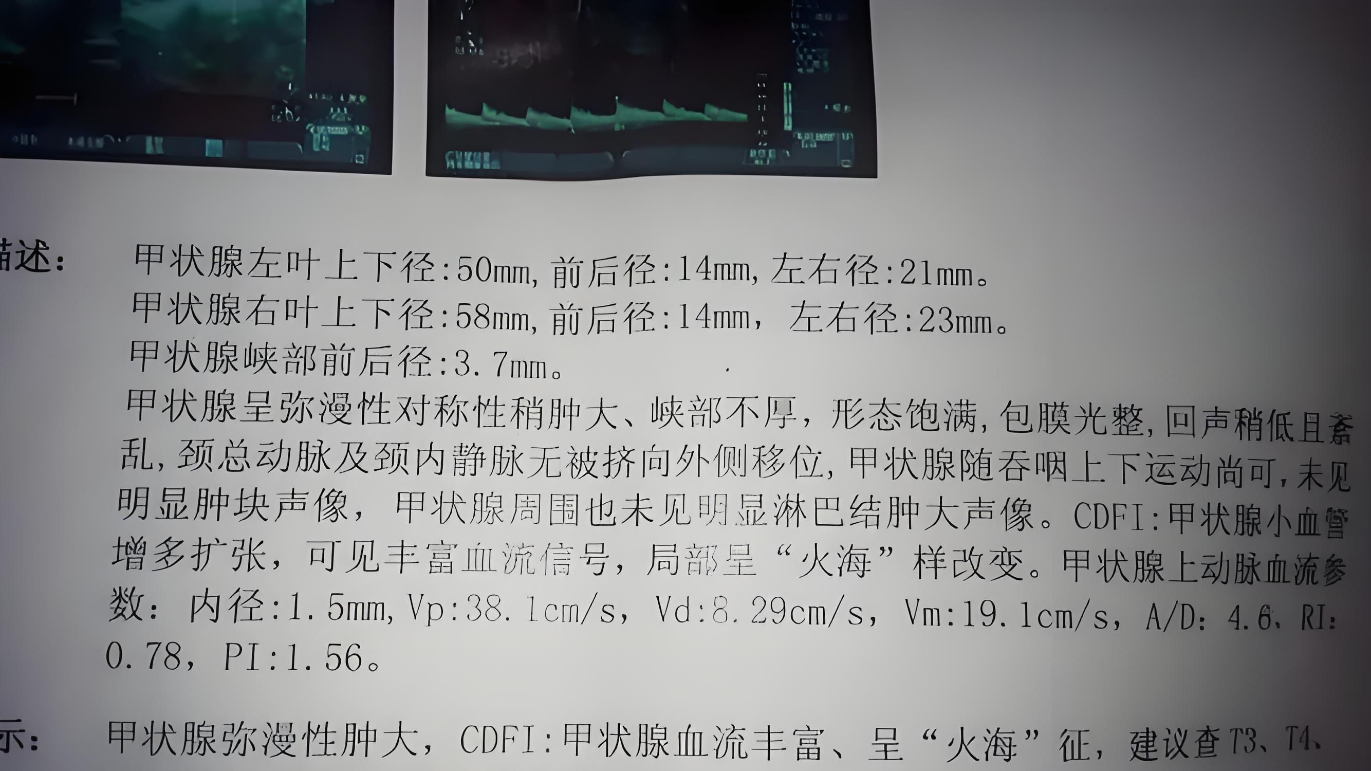 甲状腺结节4类, 代表什么含义?