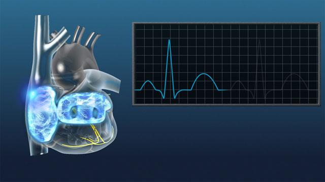 FDA批准阵发性室上性心动过速首款自行给药鼻喷雾剂上市