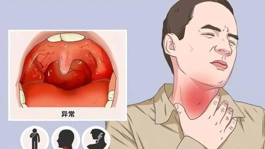 喉部不适别忽视！咽喉炎可能比你想象的更危险！