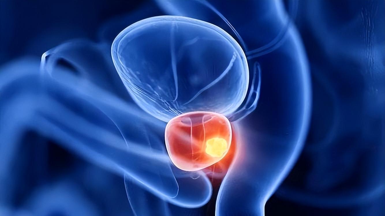 50岁后预防前列腺癌，这些信号别误判为普通增生，做好早期筛查