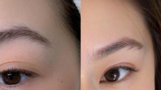 水光针好还是光子嫩肤好？带你深度解析