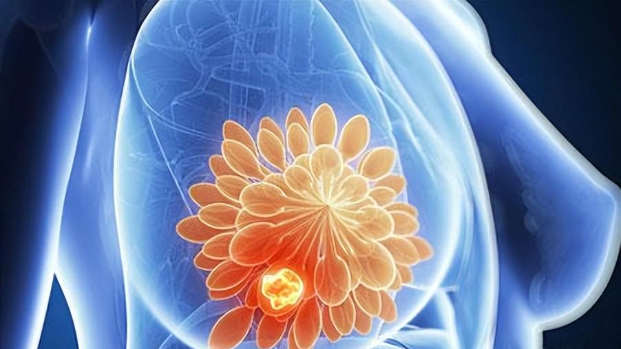 乳腺癌≠绝症，早期发现90%是可以治愈，出现5类症状要做好筛查