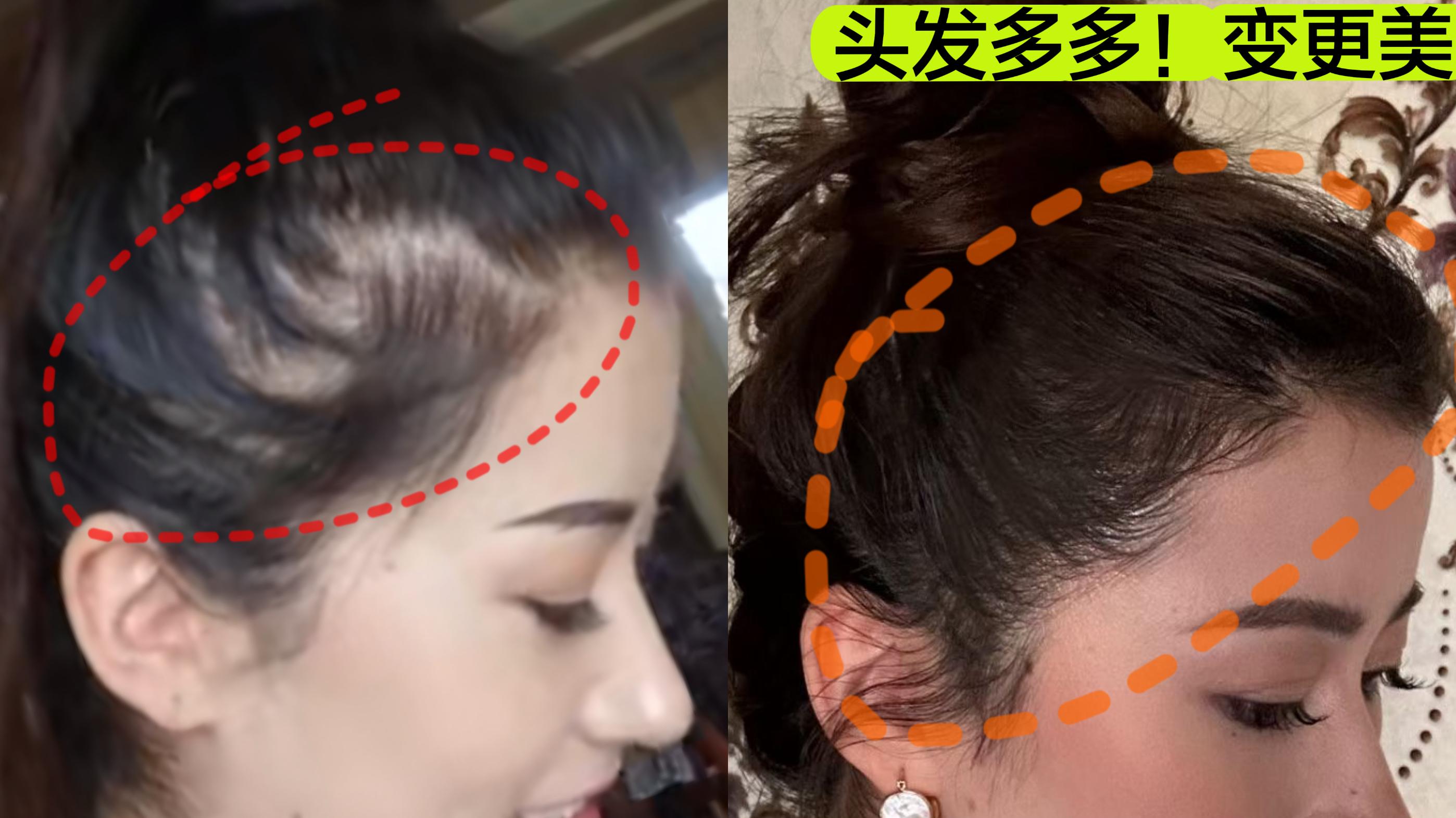 亲身分享 | 我是如何在一个月内，让鬓角“发芽”的