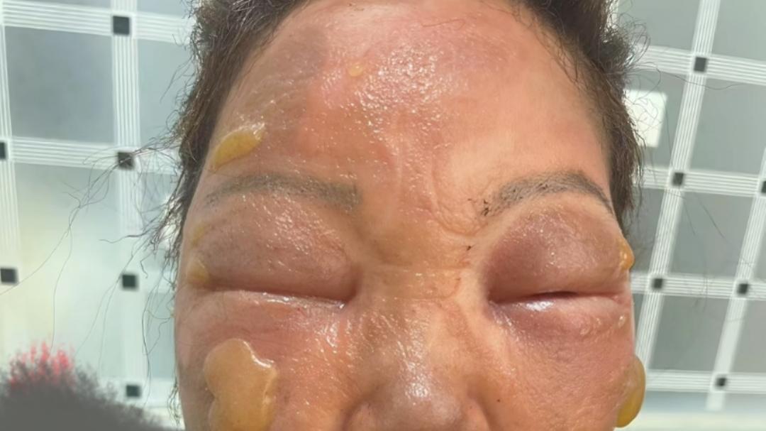 卡式炉爆炸是有多危险？网友晒出多人被炸伤图，看完不由得冒冷汗