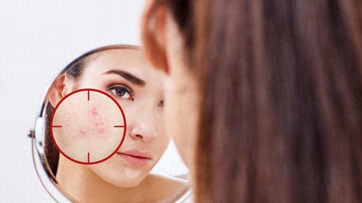 去皮肤科看痘痘，为啥医生总开异维A酸软胶囊？