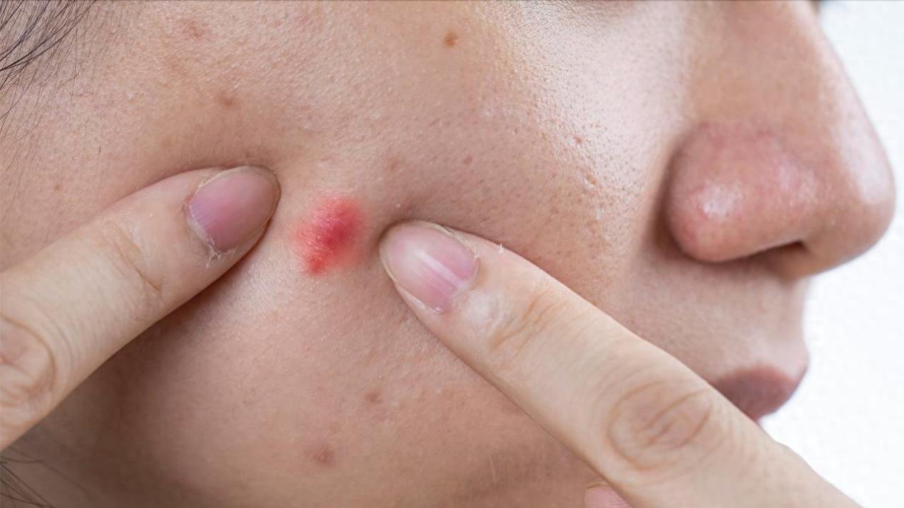 祛痘克星异维A酸软胶囊：合理使用与避坑指南