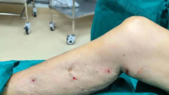 湖北82岁婆婆静脉曲张，30分钟微创术后，走路轻快腿不疼了