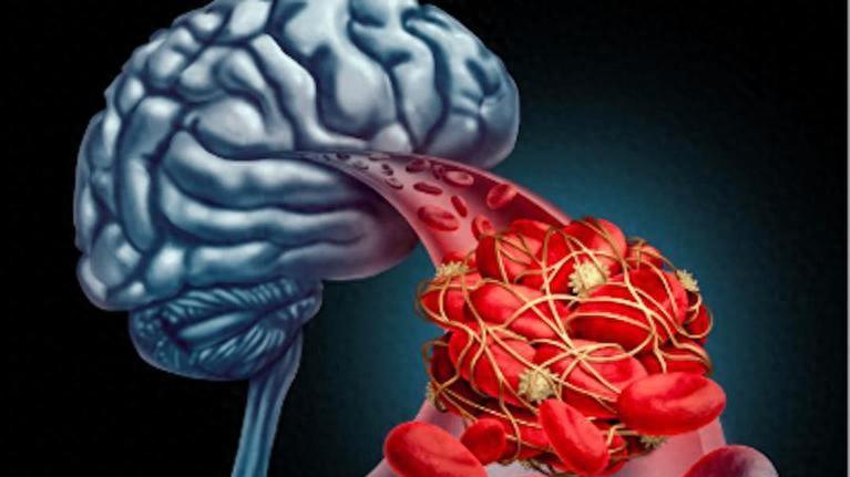 脑梗塞发作时，这些症状别忽视，记住"FAST"原则，5秒快速识别