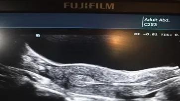 试管婴儿胚胎移植时，能通过B超看到胚胎宝宝吗？