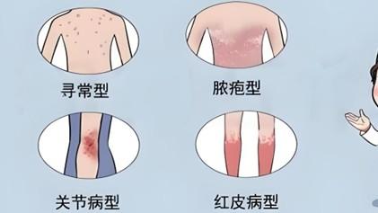 牛皮癣外用药膏哪种比较好又不含有激素，口服药能不能停？