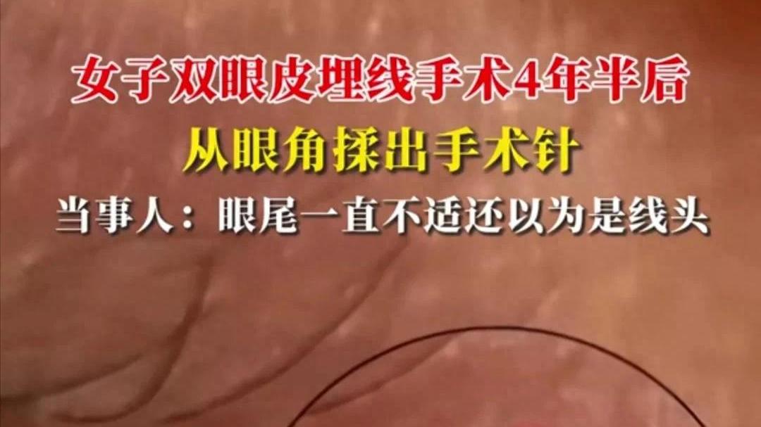 女子双眼皮手术多年后从眼角揉出手术针，当事人讲述引热议