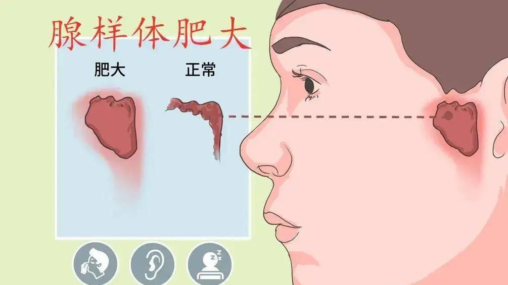 孩子总张嘴喘气？警惕腺样体肥大，可能悄悄改变面容！