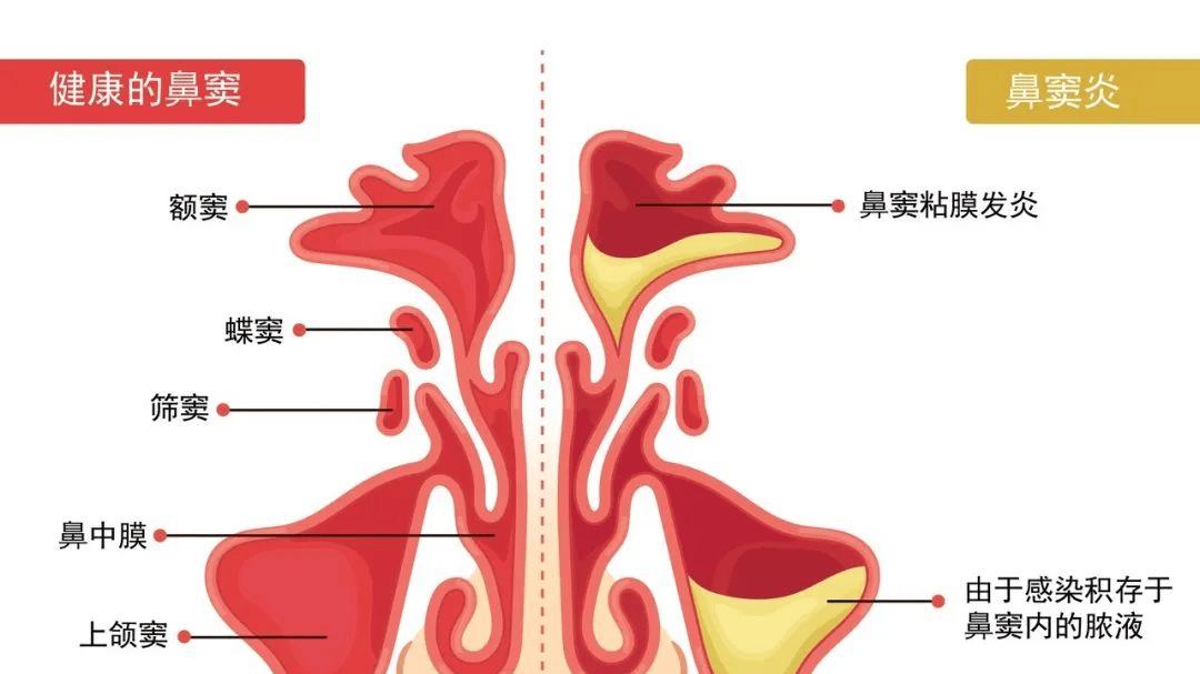儿童鼻窦炎的危害有多大？有以下情况，务必带孩子检查！