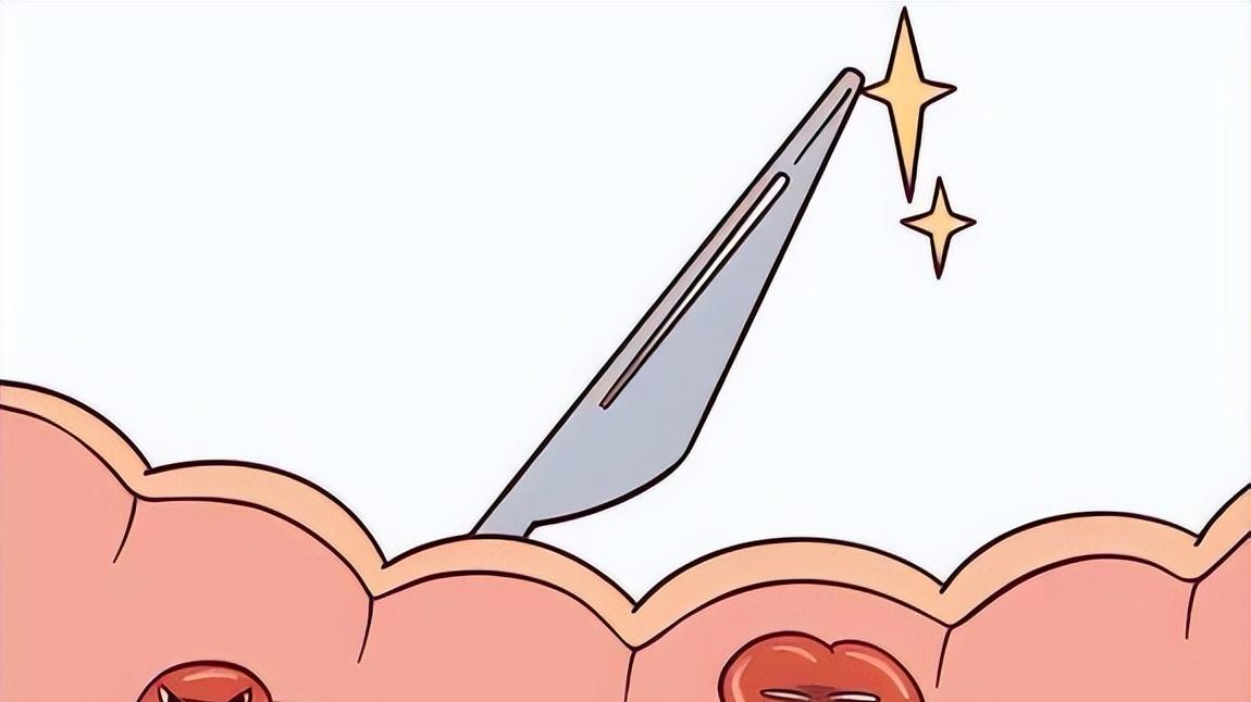 得了肠息肉，别慌，息肉不等于癌，50岁以后肠镜筛查是关键