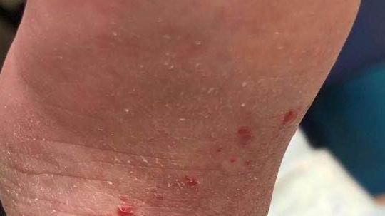 科普：血管瘤如何预防